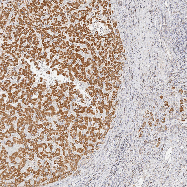 Severe Alcoholic Hepatitis Liver Sample