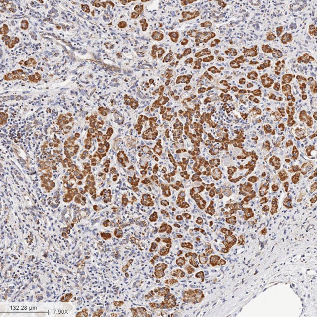 Severe Alcoholic Hepatitis Liver Sample