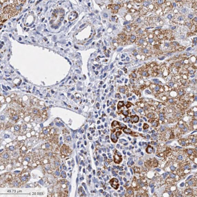 Severe Alcoholic Hepatitis Liver Sample