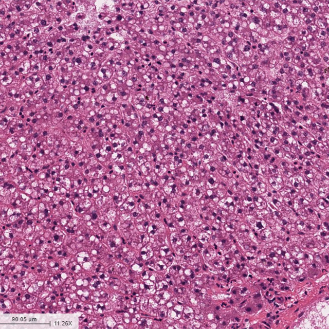Severe Alcoholic Hepatitis Liver Sample