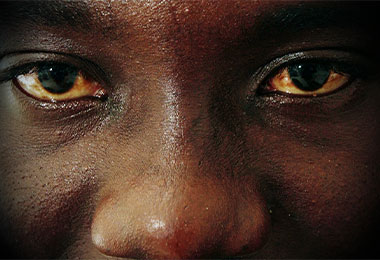 A man with bloodshot uveitis-afflicted eyes.
