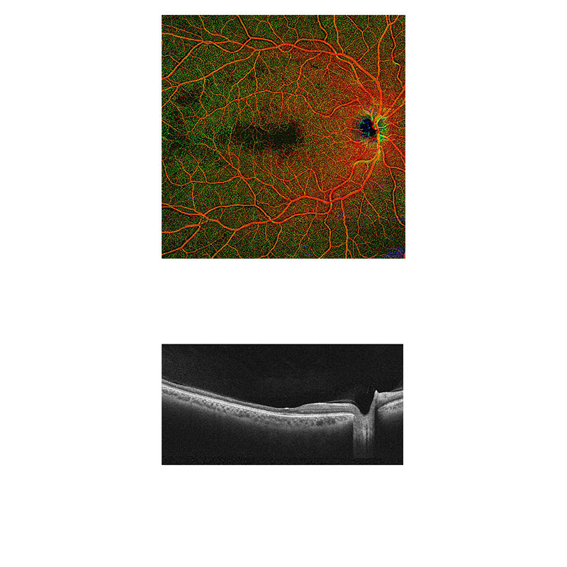 OCTA images of sickle cell retinopathy