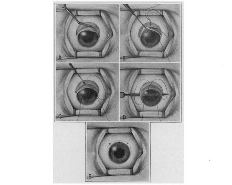 Textbook illustration showing five steps of a cataract surgery procedure. The lens of the eye is sewed back with sutures linking the flap with the sclera.