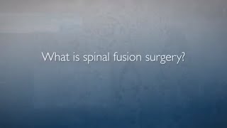 Approaches to Spinal Fusion  FAQs