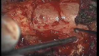 Dr Ali Bydon Performs A Spinal Synovial Cyst Resection