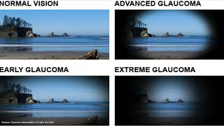 Glaucoma  An Introduction for Patients