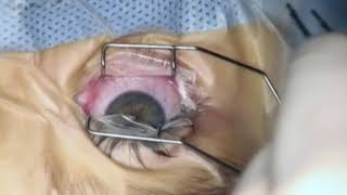 Inferior Oblique Myectomy Using the Tenon Pullup Technique