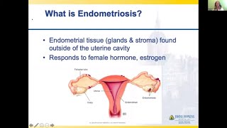 Myths  Misconceptions Understanding Endometriosis and Uterine Fibroids Webinar