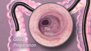 The Importance of Good Bowel Preparation During Colonoscopy