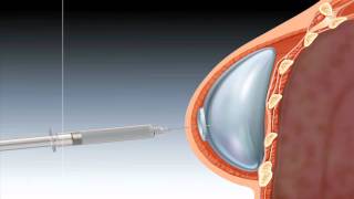 Tissue Expander for Staged Breast Reconstruction