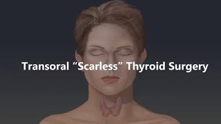 Transoral Scarless Thyroid Surgery Animation