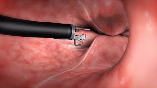 What Happens During the Endoscopic Sleeve Gastroplasty Procedure