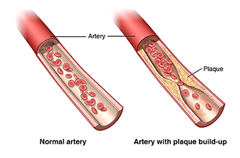 Normal artery and artery with plaque buildup