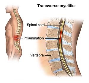 Illustation showing inflammation in lumbar region of the spine due to transverse myelitis