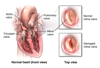 A normal and damaged mitral valve