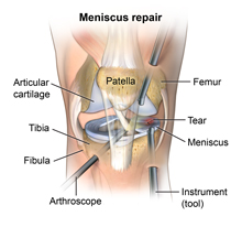 Arthroscopic meniscus repair