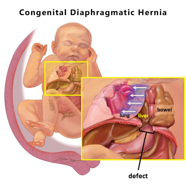Diagram showing the defect associated with congenital diaphragmatic hernia