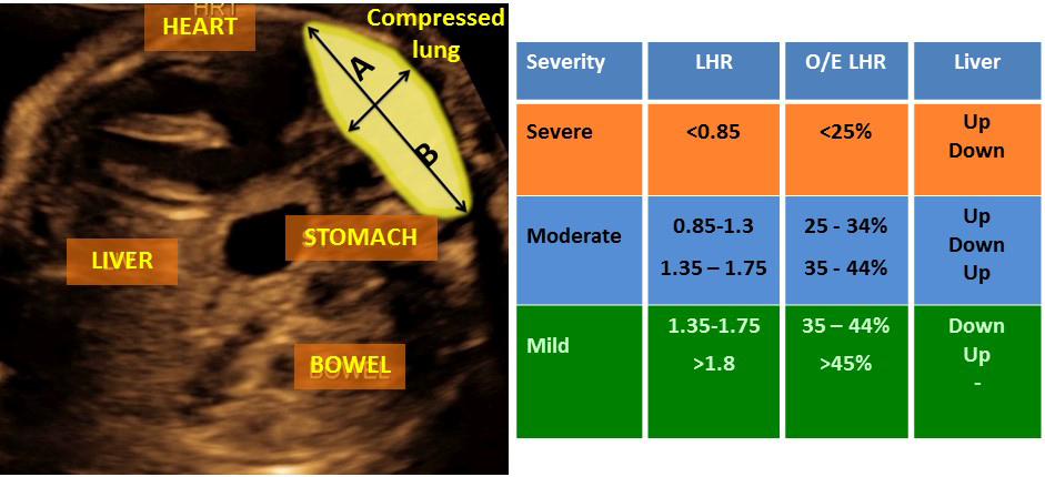 Ultrasound of a baby with congenital diaphragmatic hernia