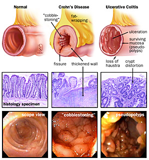 Crohn's Disease  Johns Hopkins Medicine