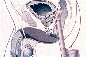 Transrectal ultrasound diagram