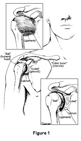Diagram showing where shoulder instability occurs