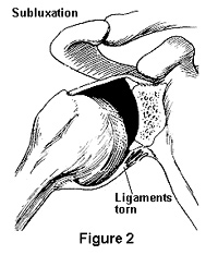 Diagram showing a torn shoulder ligament