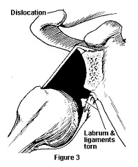 Diagram showing a torn shoulder ligament and labrum