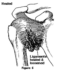 Diagram showing ligaments healed and loosened