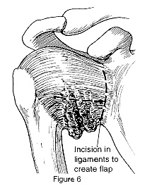Diagram showing incision created along the ligaments to create a flap