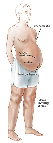 Signs of portal hypertension, including gynecomastia, caput medusae, ascites, umbilical hernia, and swelling of the legs.