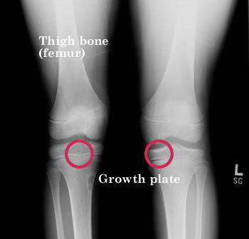 X-ray of the knees, identifying the location of the growth plates