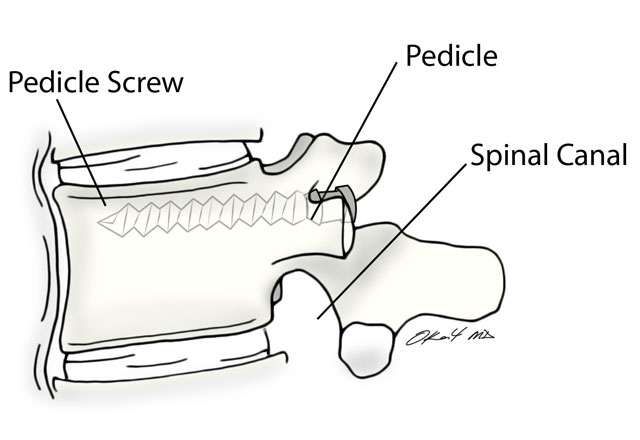 Illustration showing the pedicle screw through the pedicle