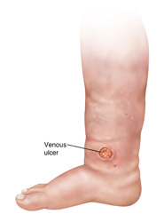 Illustration of a venous ulcer