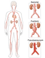 Illustration of the different types of aortic aneurysm
