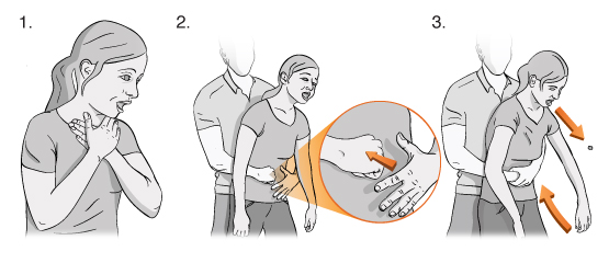 Illustration showing a woman choking, a man grabbing her around her stomach from behind, and using his fist and hand to perform the choking rescue technique.