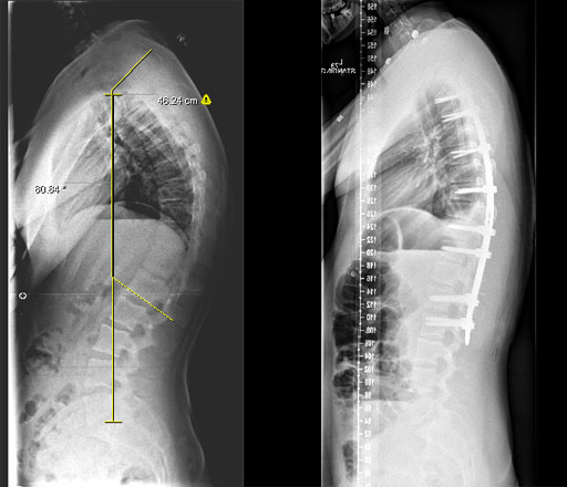 X-ray slide showing the improved spinal curve after surgery for kyphosis