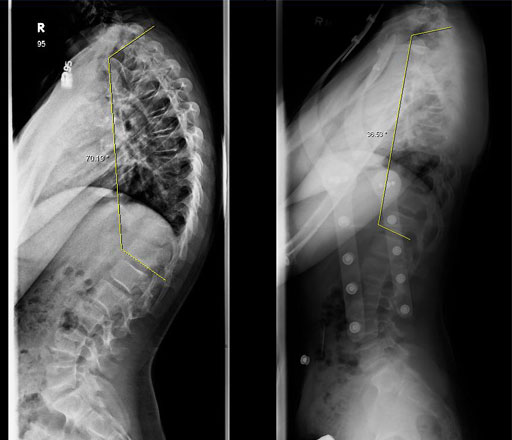 X-ray slide showing the improved spinal curve after bracing for kyphosis