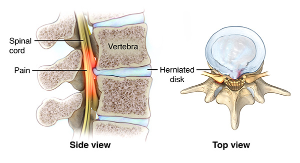 An illustration of how a herniated disc can put pressure on the spinal cord resulting in myelopathy