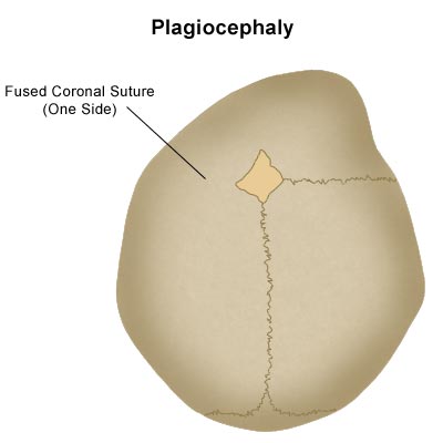 Diagram of a baby's head with plagiocephaly, showing a fused coronal suture on one side.