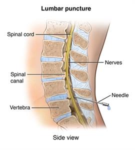 Illustration showing a lumbar puncture procedure