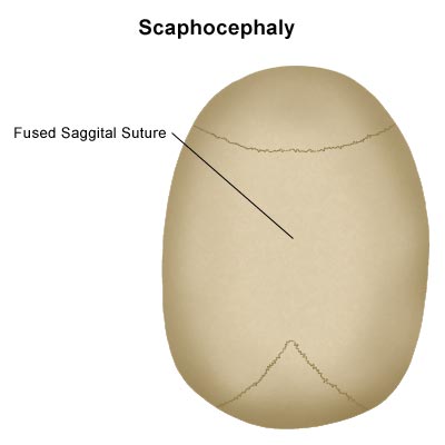 Diagram of a baby's head with scaphocephaly, showing a fused saggital suture.