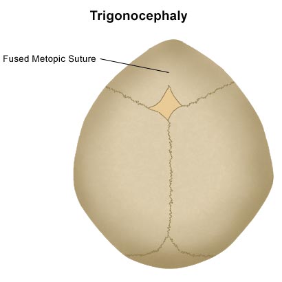 Diagram of a baby's head with trigonocephaly, showing a fused metopic suture.