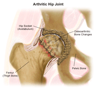 Illustration of an Arthritic Hip Joint