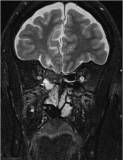Post-op image of an encephalocele