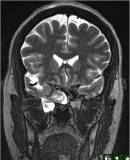 Pre-op image of an encephalocele