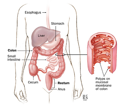 Location of the colon in the body with corresponding cut-away section of a colon segment with polyps.