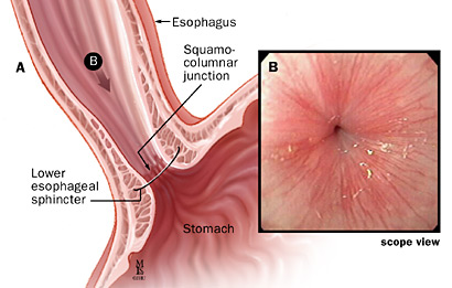 A: Lower esophageal sphincter and squamocolumnar junction; B: Endoscopic view