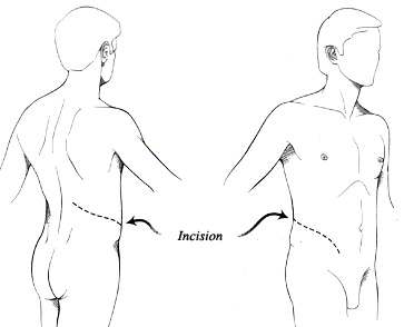 Diagram of open surgery incision across the abdomen