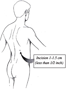 Diagram showing one small incision on the midback