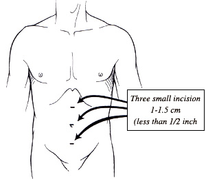 Diagram of laparoscopic incision across the abdomen